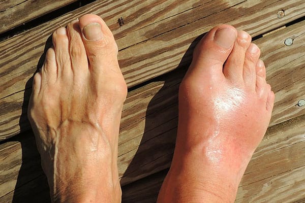 Dos pies: una normal y otro inflamado