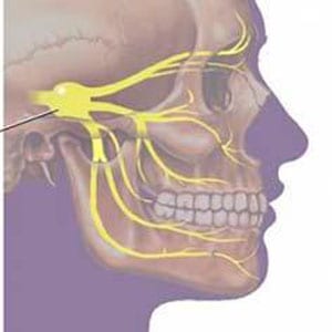 Esquema de las terminaciones nerviosas para la migraña