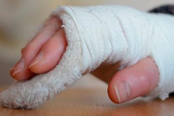 Persona con la mano escayolada