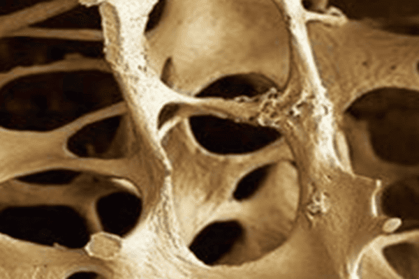 Huesos con osteoporosis