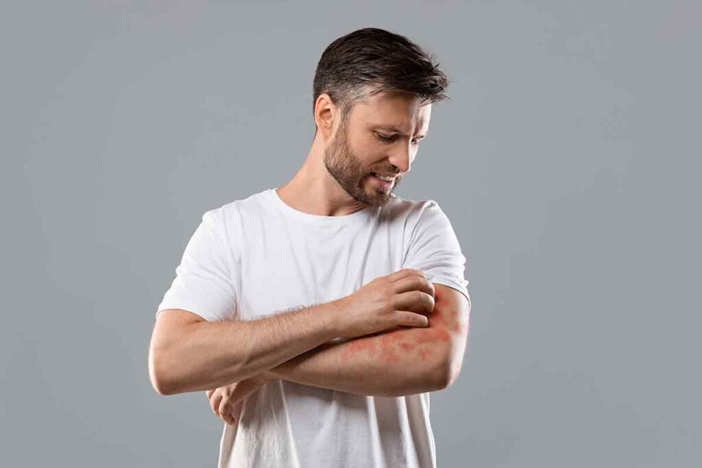 Enfermedades de la piel por disbiosis en la microbiota intestinal: psoriasis, dermatitis y acné