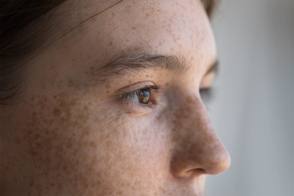 Una chica con manchas marrones en la piel en la zona de la cara y nariz