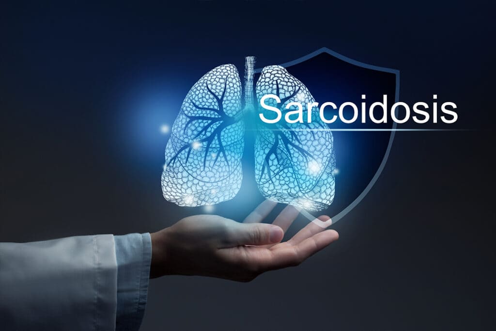 Que es la sarcoidosis