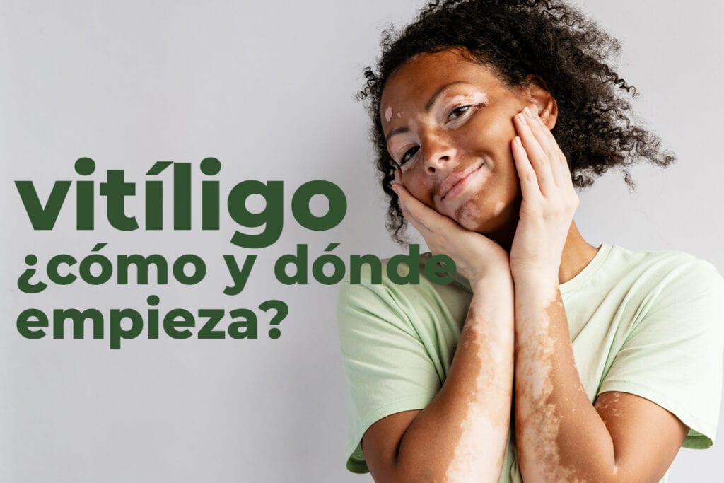 Una chica con vitíligo en manos y piel explica que es y como y donde empiezan las manchas blancas en la piel