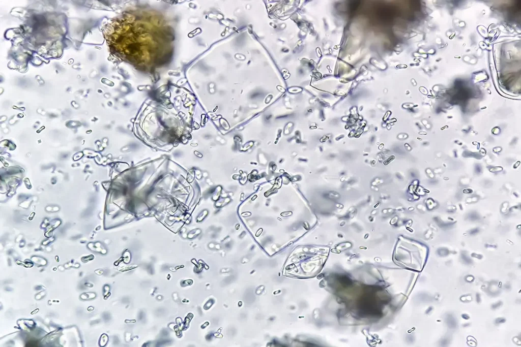 Cristales de ácido úrico bajo el microscopio, asociados con la gota.